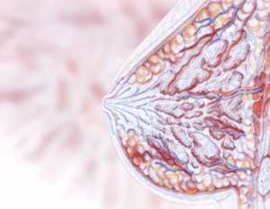 Понимание рака молочной железы: симптомы, диагностика и лечение