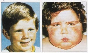 как выглядит мальчик до и после болезни Иценко-Кушинга фото